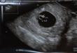 Что происходит с эмбрионом на шестой неделе беременности?